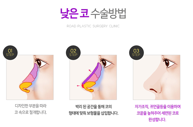 목동성형외과 코수술 잘하는곳 궁금하다면 관련 이미지 4