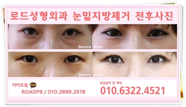 /강서구눈성형/ 로드성형외과에서 눈밑을 밝히다! 관련 이미지 3