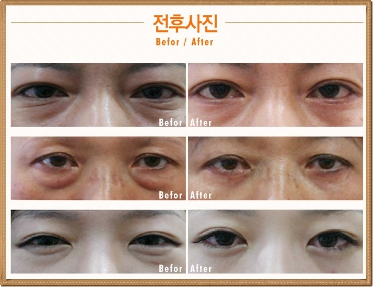 (구.아이리스)◆로드성형외과◆화곡동눈밑지방제거 잘하는 곳 관련 이미지 2