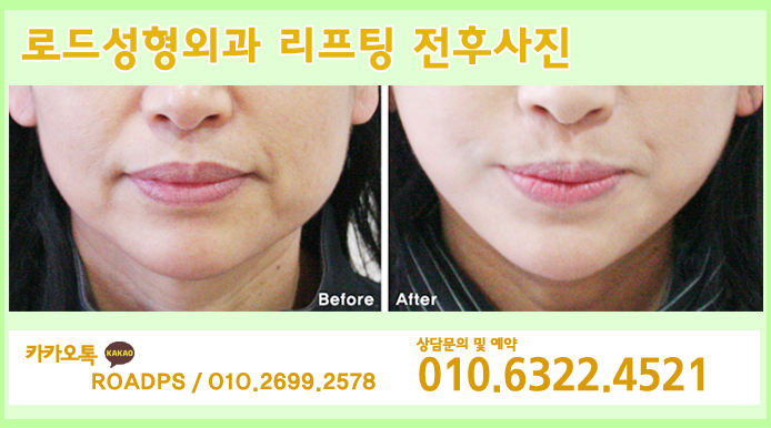 신정역리프팅 잘하는 로드성형외과 입니다&hearts; 관련 이미지 3