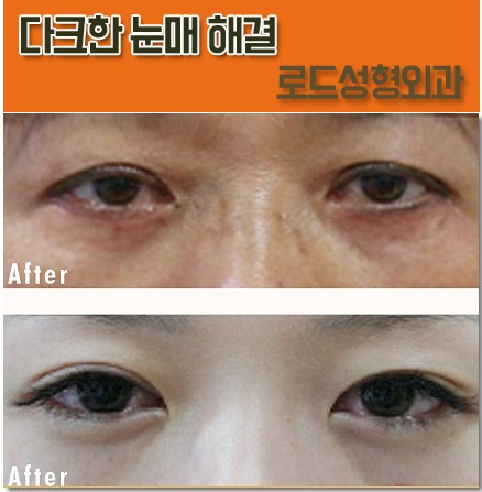 화곡역눈밑필러 완성되는 화사함 관련 이미지 2
