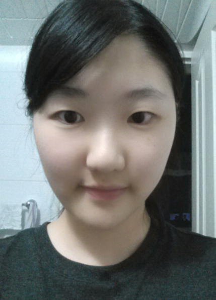 [까치산성형외과 로드성형외과에서 알려드리는 트임성형 정보 ♬] 관련 이미지 6