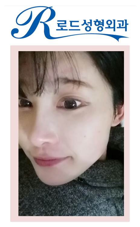 [까치산역성형외과 로드성형외과에서 알려드리는 복코성형 정보 ♬] 관련 이미지 5