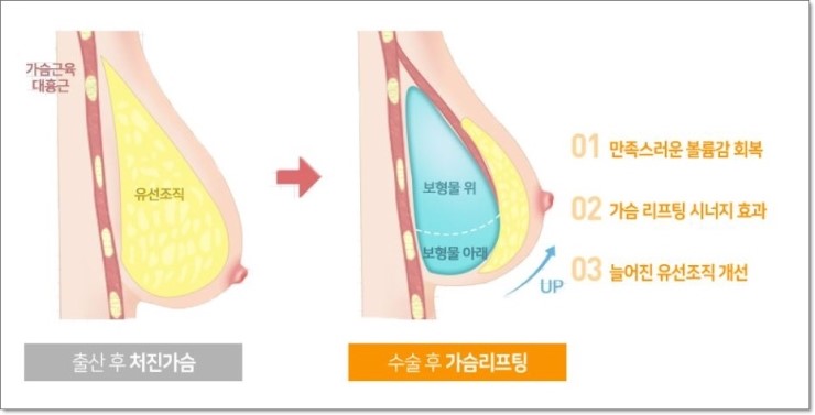 까치산역가슴성형 자연스런 가슴확대수술 관련 이미지 2