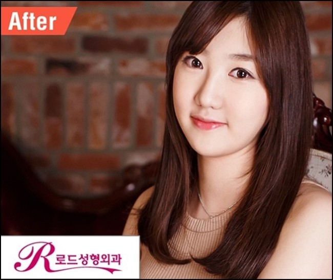 목동역눈성형 예쁜 라인 만드는 로드성형외과 관련 이미지 2