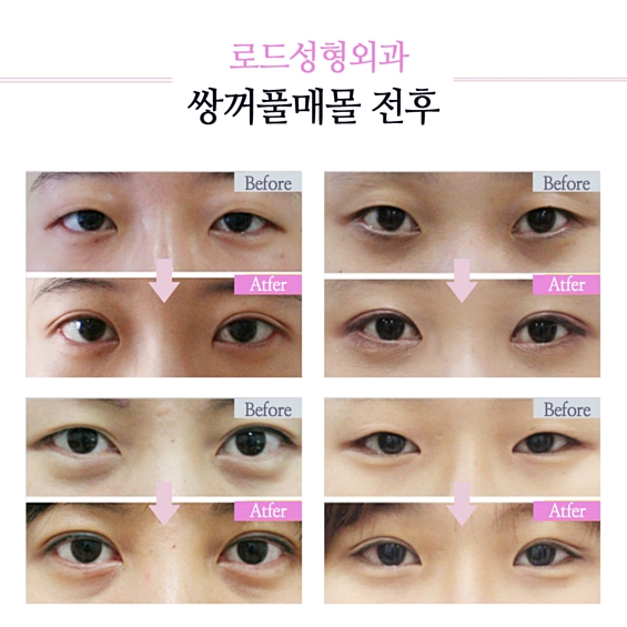 강서구성형외과 쌍꺼풀, 매력적이게 바뀐다! 관련 이미지 3
