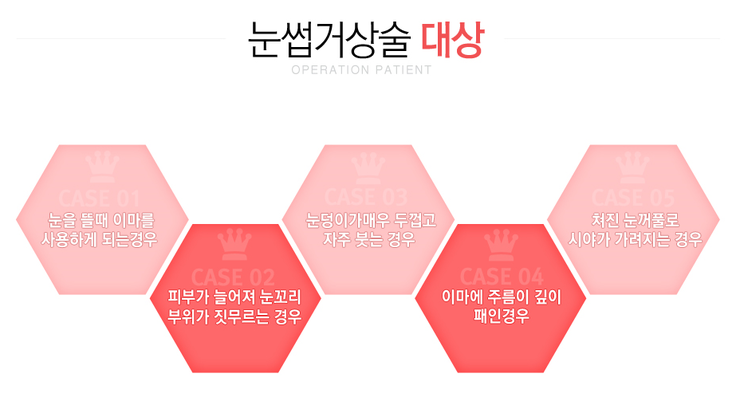 [까치산성형외과 로드성형외과에서 알려드리는 눈썹거상술 정보 ♬] 관련 이미지 2