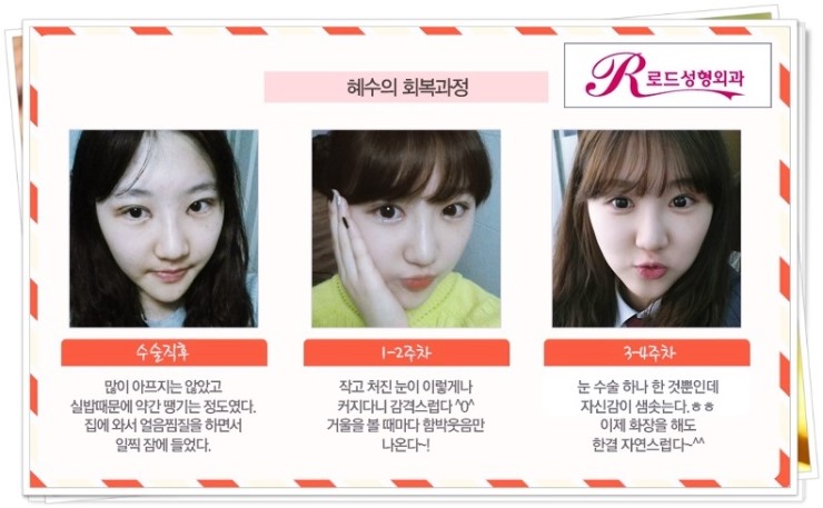 화곡동쌍꺼풀수술 티안나게 만들기 관련 이미지 2