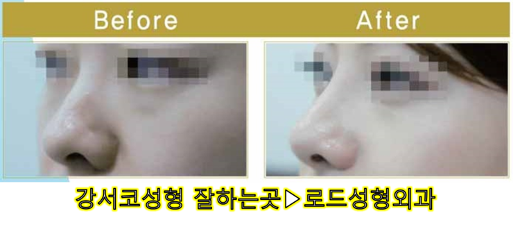 [로드성형외과] 강서코성형 잘하는곳! 관련 이미지 1