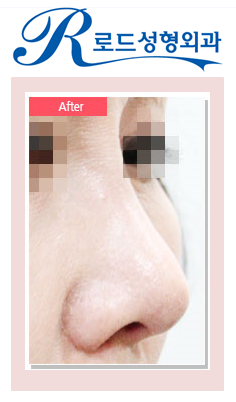 [까치산역성형외과 로드성형외과에서 알려드리는 코재수술 정보 ♬] 관련 이미지 5