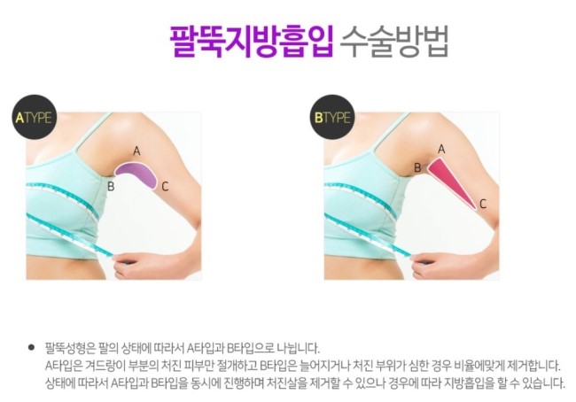 목동지방흡입 매끈한 라인을 위하여! 관련 이미지 3