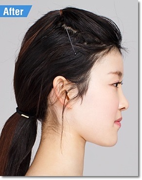 화곡동코수술잘하는곳 확실히 여기 관련 이미지 4
