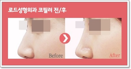 목동필러 볼륨과 아름다움을 채워주는 로드! 관련 이미지 3