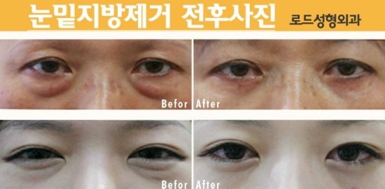 ＠강서구성형외과＠ 다크써클 없애는 방법! 관련 이미지 2