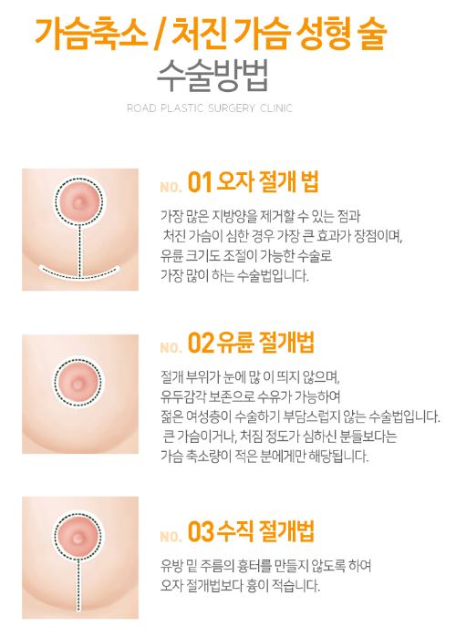 까치산역가슴성형 큰가슴이 고민이라면? 관련 이미지 3