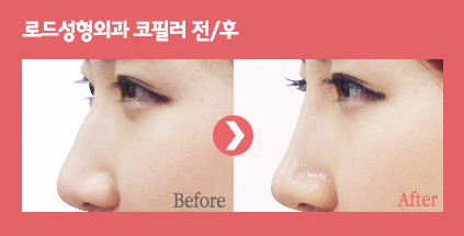 화곡동코필러는 바로 로드성형외과입니다! 관련 이미지 2