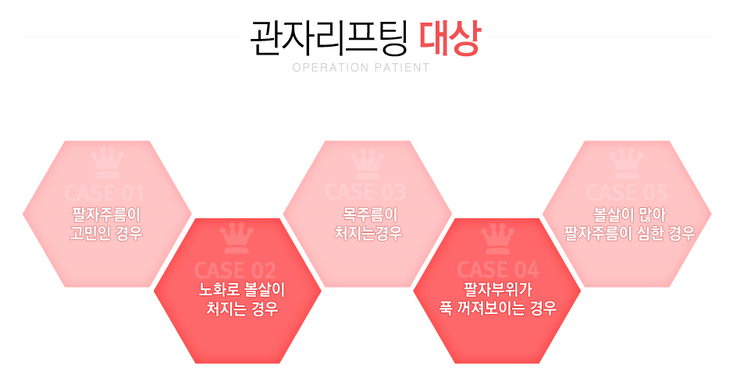 [화곡동성형외과 로드성형외과에서 알려드리는 관자리프팅 정보 ♬] 관련 이미지 2
