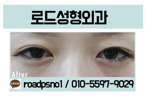 목동눈밑필러잘하는곳 바로 선택 관련 이미지 4