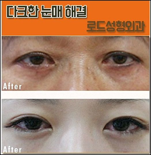 화곡동눈밑필러 칙칙함을 없애자, 로드성형외과 관련 이미지 2