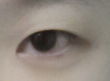 [까치산역성형외과 로드성형외과에서 알려드리는 눈성형 정보 ♬] 관련 이미지 6