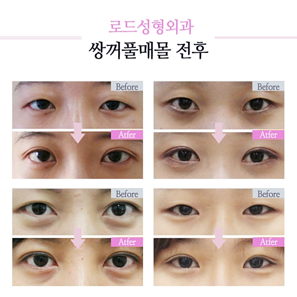 목동성형외과, 여름방학 눈성형 여기! 관련 이미지 5