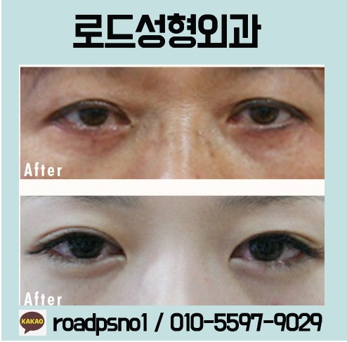 화곡동눈밑필러 유명한곳 여기 관련 이미지 3