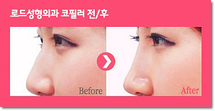 화곡동코필러 예쁜인상 만들기 관련 이미지 2