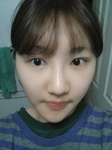 [화곡역성형외과 로드성형외과에서 알려드리는 눈성형 정보 ♬] 관련 이미지 6