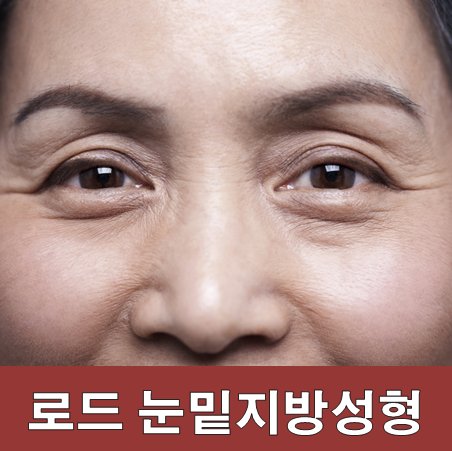 강서구눈밑지방성형 잘하는곳 ♬ 아이리스/로드성형외과 관련 이미지 1