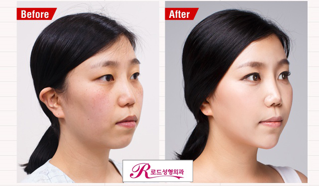 까치산역지방이식 아무도모르게 변신 관련 이미지 2