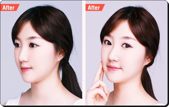 /목동코성형/ 오똑하게 만들자 관련 이미지 4