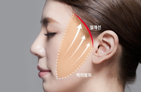 강서구리프팅 부러워할만해 관련 이미지 2