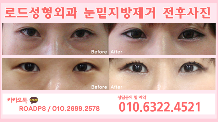 강서구성형외과 어두운 다크써클은 이제 끝 관련 이미지 3