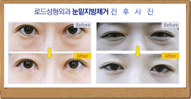 강서구성형외과에서 다크서클로부터 벗어나자! 관련 이미지 2