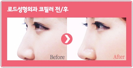 강서구코필러 부담없이 매끈하게 관련 이미지 3
