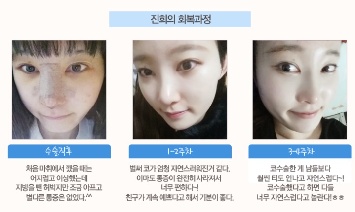 강서구코성형 맡기니 아름다워졌다 관련 이미지 3