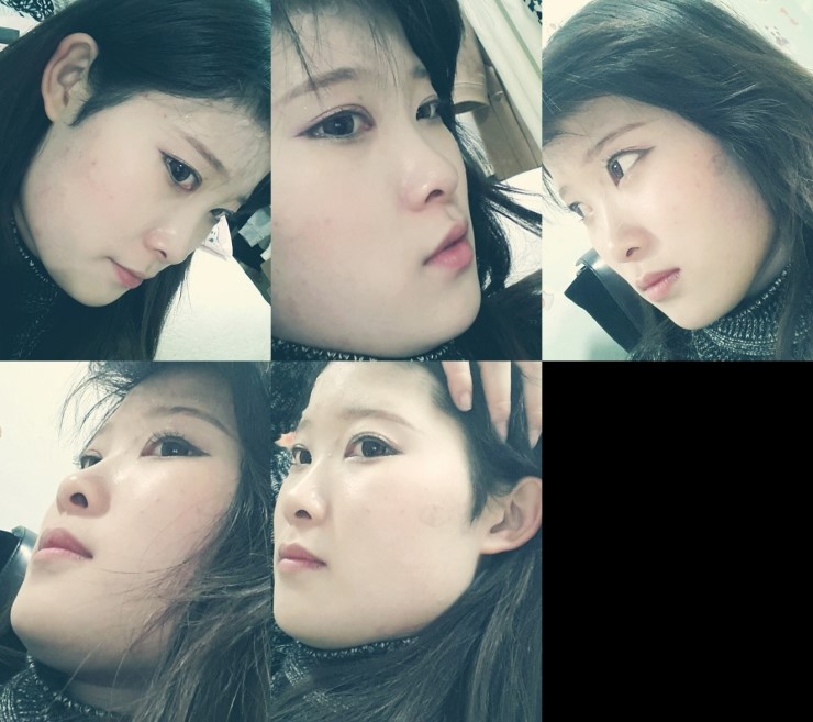 [로드성형외과] 진희의 이마지방이식, 코성형 후기! 관련 이미지 1