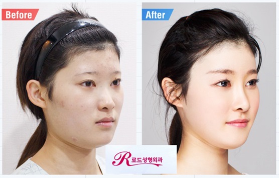 목동코성형 날렵하고 오똑하게 관련 이미지 3