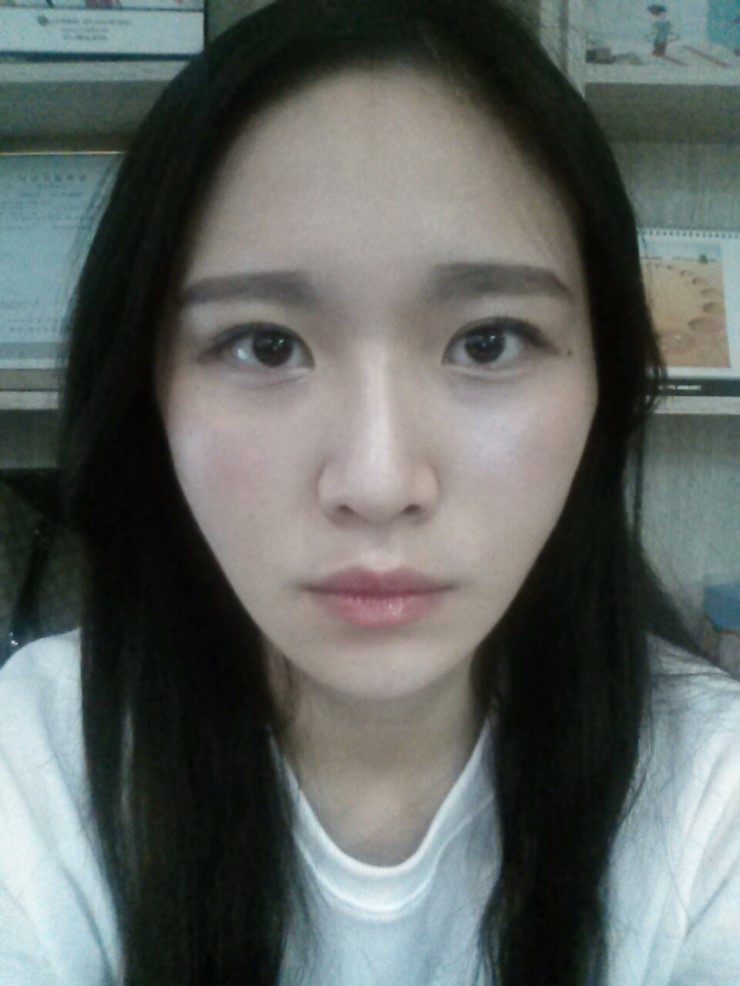 [로드성형외과] 리나의 볼리프팅, 볼지방이식, 앞광대지방이식 후기! 관련 이미지 1
