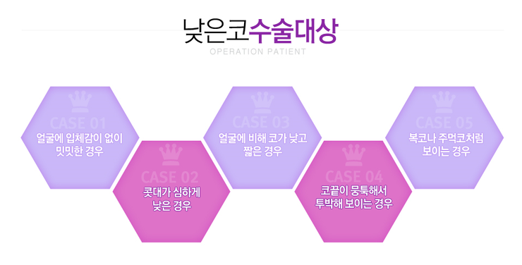 [화곡동성형외과 로드성형외과에서 알려드리는 낮은코성형 정보 ♬] 관련 이미지 2