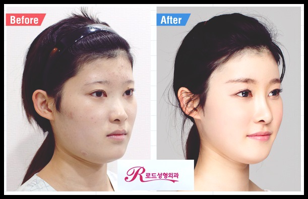 강서구코성형 잘하는 병원 ■로드성형외과■ 관련 이미지 4