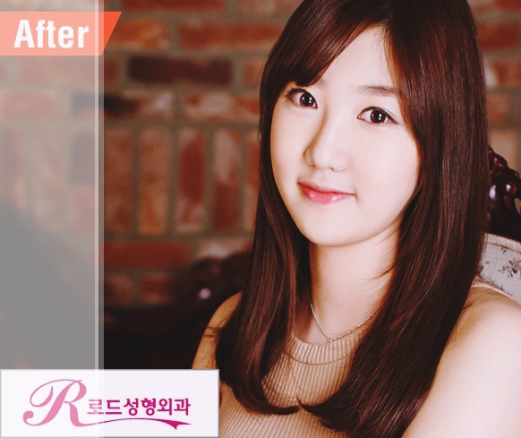 강서구눈성형 한지 모를 자연스러움 관련 이미지 2
