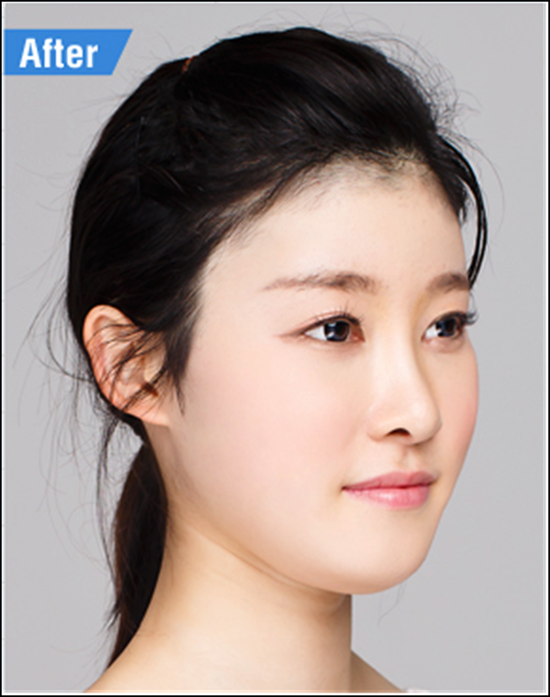 목동코성형 예쁜 코를 원한다면? 로드성형외과 관련 이미지 4