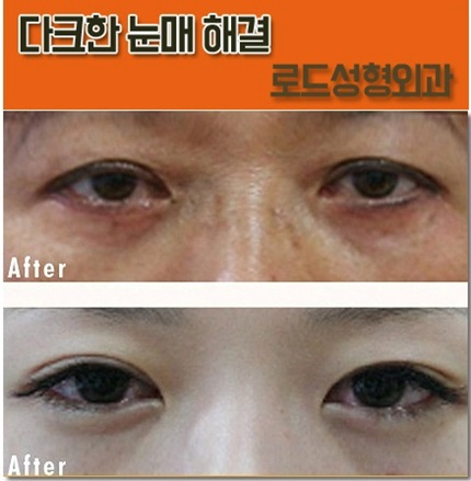 강서구눈밑필러잘하는곳 다크해결 관련 이미지 3