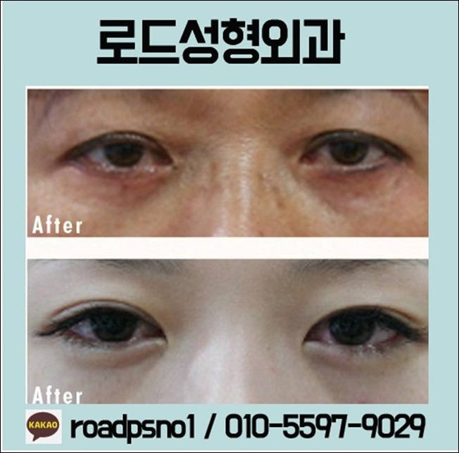 신정역눈밑필러 화사함의 완성 관련 이미지 3