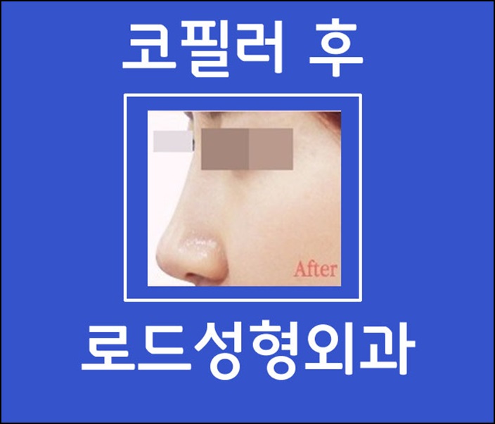 까치산역코필러 부드러운 코라인 완성 로드! 관련 이미지 2