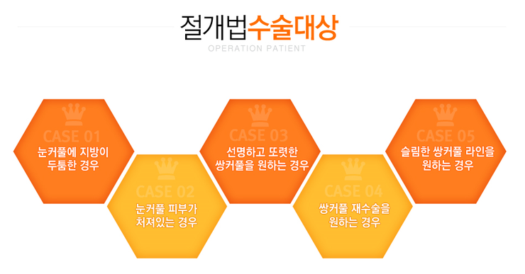 [화곡역성형외과 로드성형외과에서 알려드리는 눈성형 정보 ♬] 관련 이미지 3