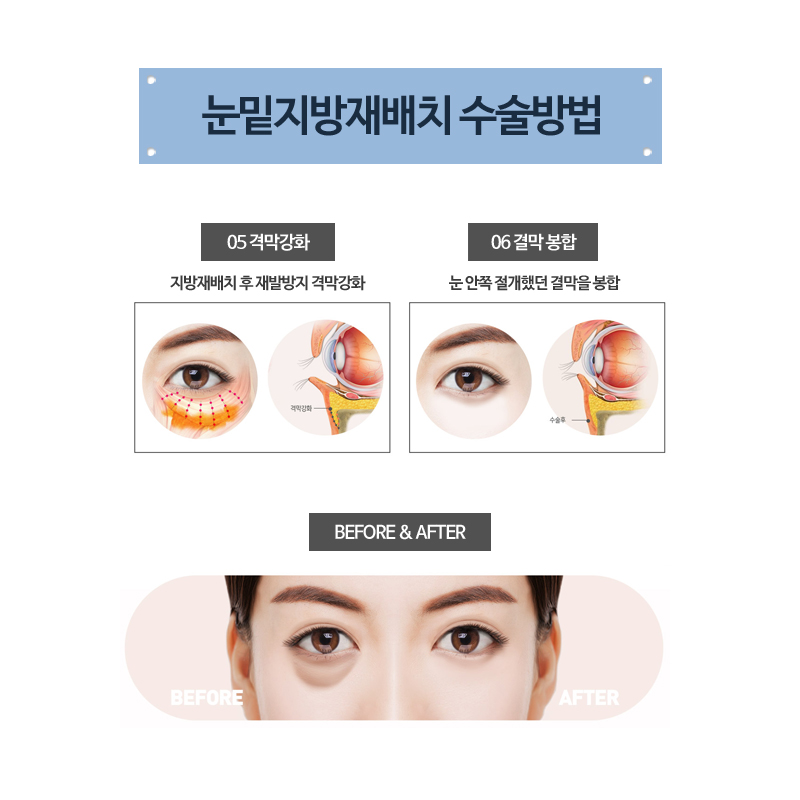 What Kind of Surgery Is Under-Eye Fat Repositioning? image 5