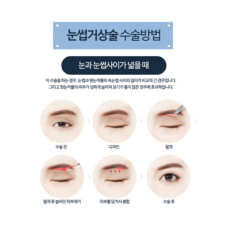 Middle-Age Eye Surgery: A Natural Youthful Eye Shape with Eyebrow Lift Surgery image 3