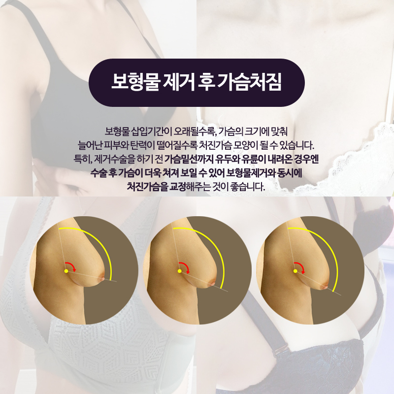 Breast Implant Removal Should Be Done Delicately and Accurately image 7